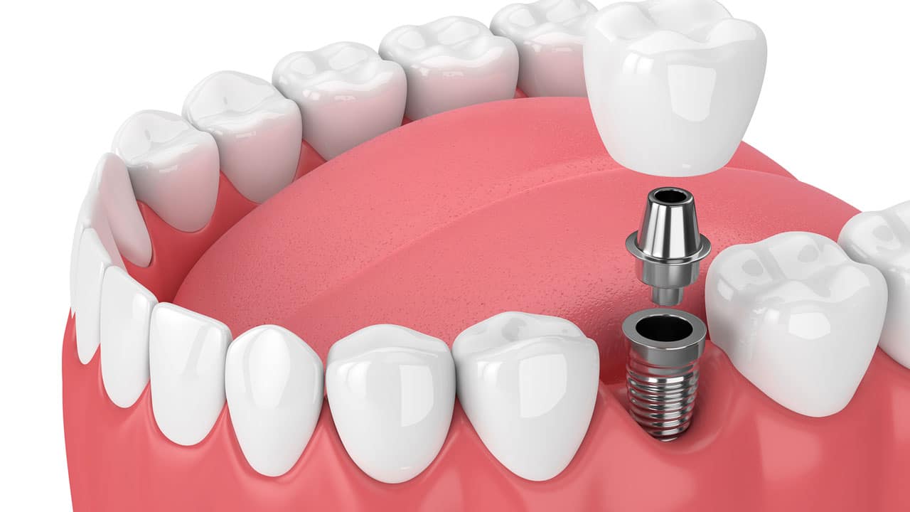 dental-implant-graphic-min.jpg